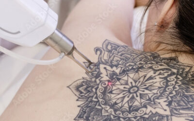 Détatouage Laser en Guadeloupe : Tout savoir sur la technologie Picosure au Centre Laser Esthetis