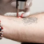 detatouage detatouage laser guadeloupe