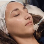 peeling peeling tca