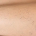 vasculaire_laser laser vasculaire