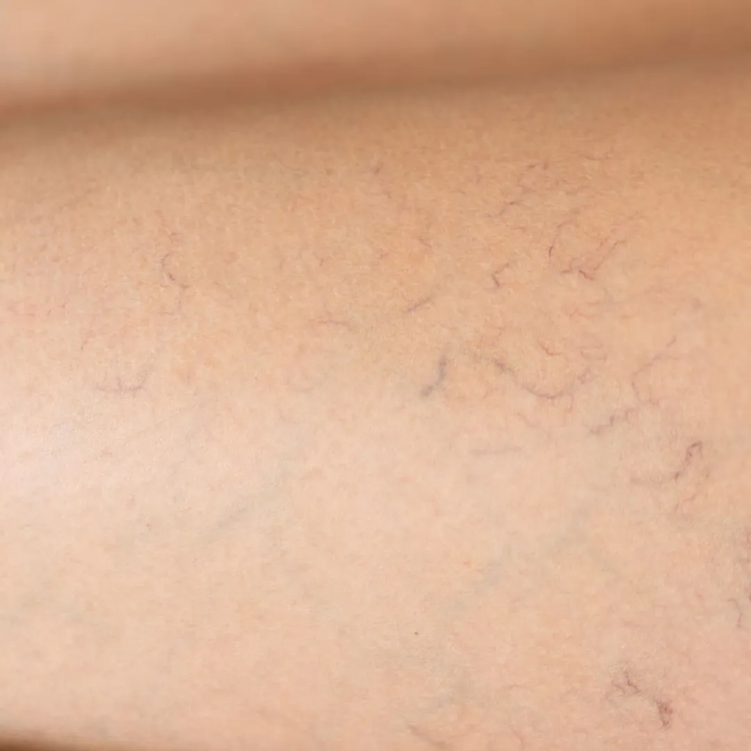 vasculaire_laser laser vasculaire